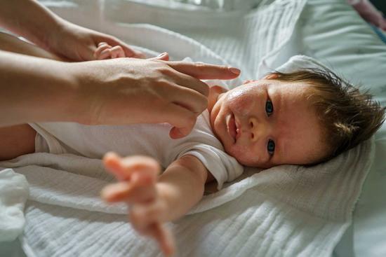 Baby mit Neurodermitis wird von der Mutter im Gesicht eingecremt