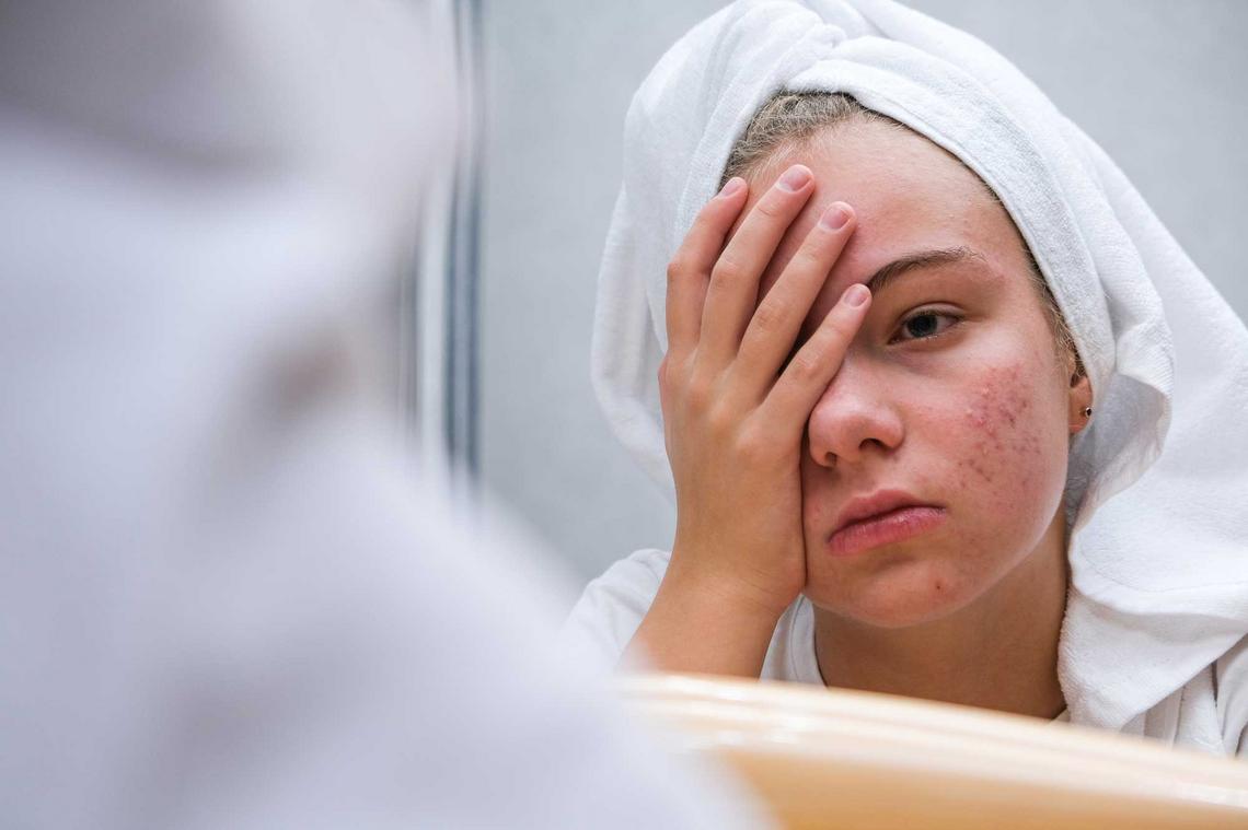 Junge Frau mit Hautproblemen im Gesicht schaut traurig in den Spiegel